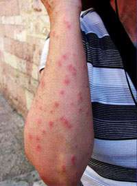 Bed_Bug_Bites_on_Arms